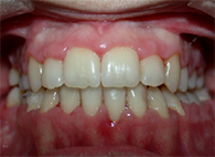 implantes dentales